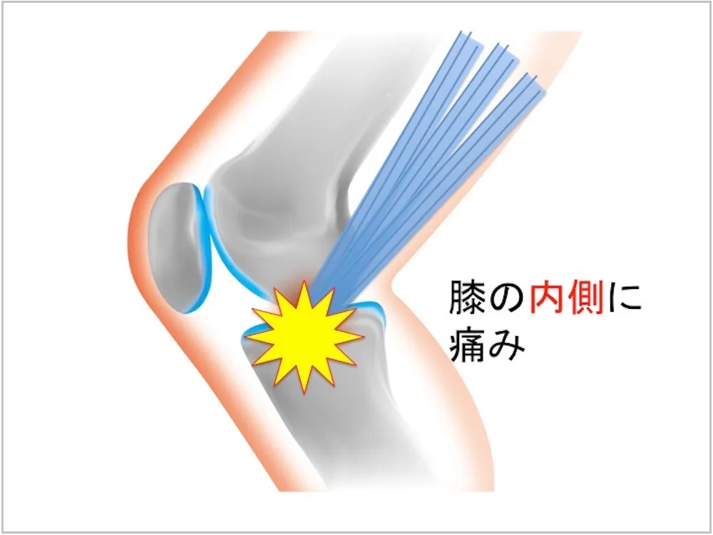 膝の内側の痛み（鵞足炎について）